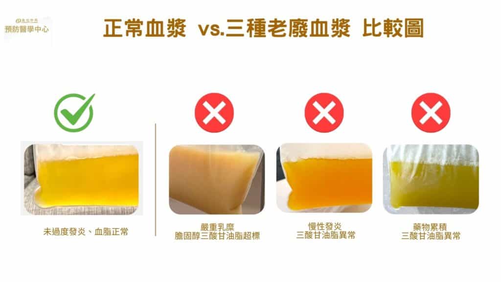 正常血漿 vs. 3種老廢血漿比較圖解
