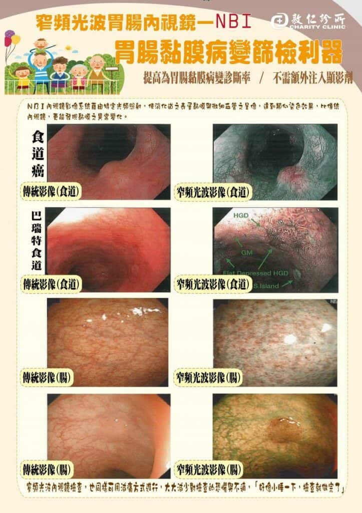 NBI 窄頻影像技術檢查食道癌照片