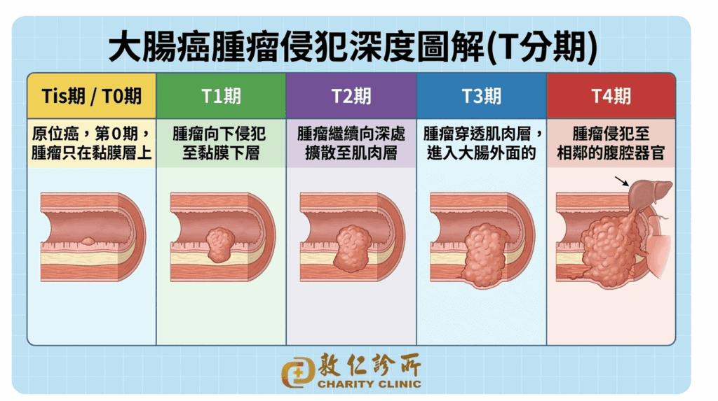 大腸癌0-4期圖解說明