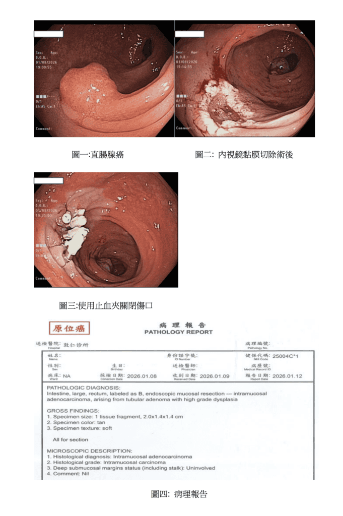 敦仁診所莊得榮醫師處理大腸原位癌的內視鏡圖片與病理報告
