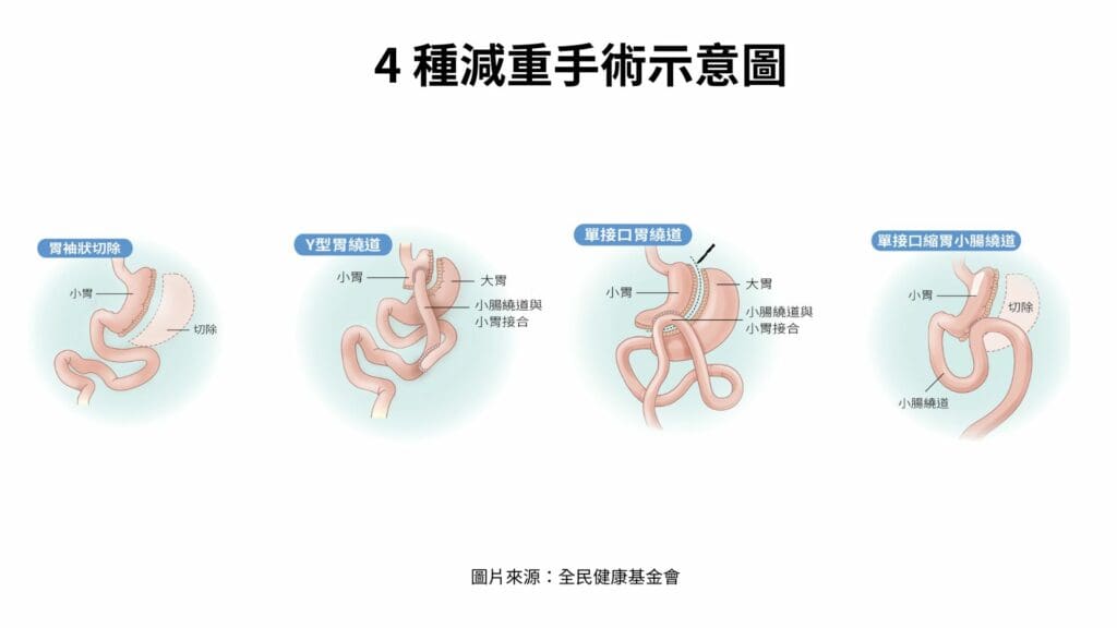 4 種減重手術示意圖
