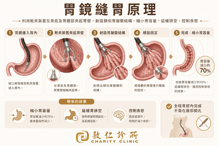 胃鏡縫胃原理圖解