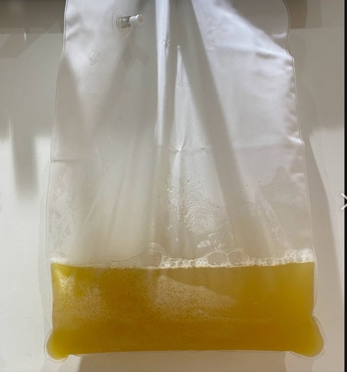MCS+ 淨血個案療程後抽血報告，HS-CRP 0.72